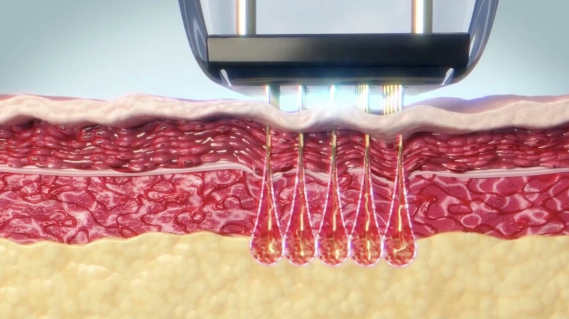 Een RF-microneedling behandeling met Sylfirm X is pijnloos door het NA-effect